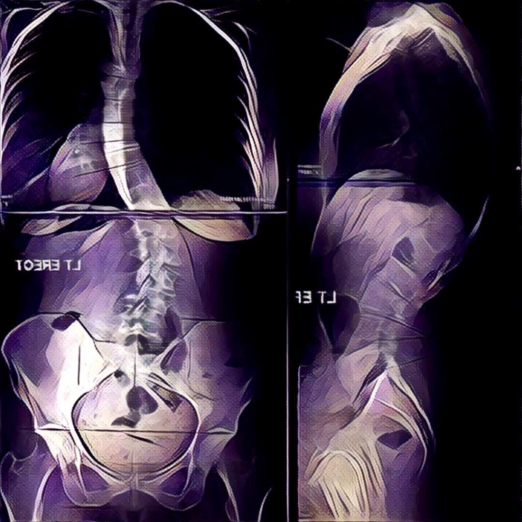 Full Spine XRays